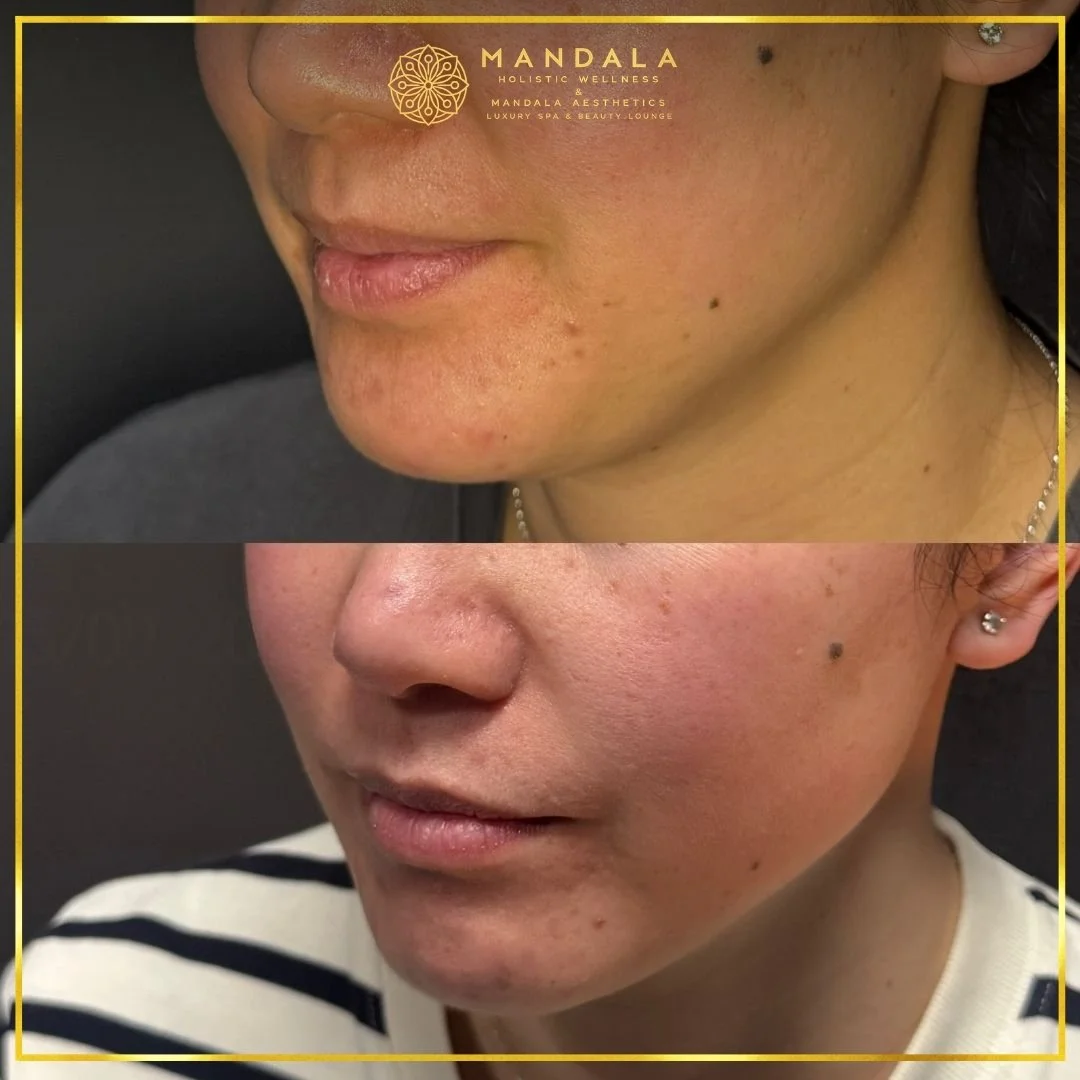 HIFU before and after results showing the lower face, chin and jawline at Mandala Aesthetics in Preston, Melbourne.