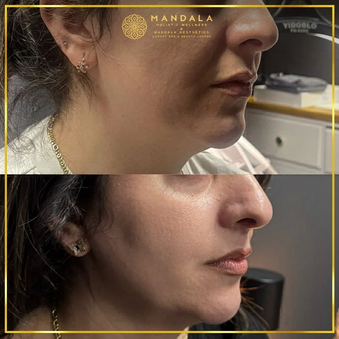 HIFU before and after results showing the lower face, chin and jawline at Mandala Aesthetics in Preston, Melbourne.