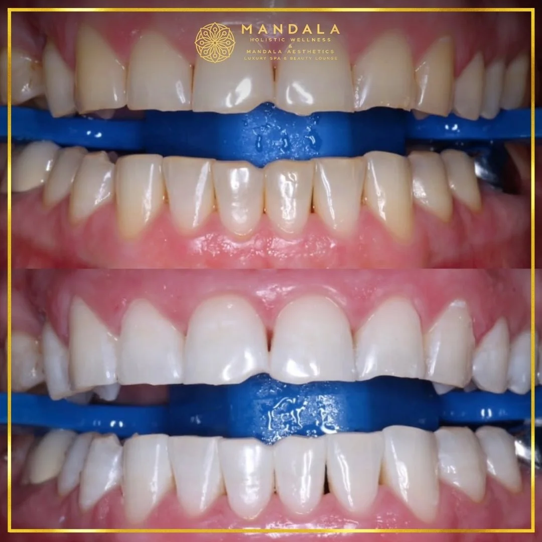 Teeth whitening before and after results showing a visibly white teeth,  brighter-looking smile at Mandala Aesthetics in Preston, Melbourne.