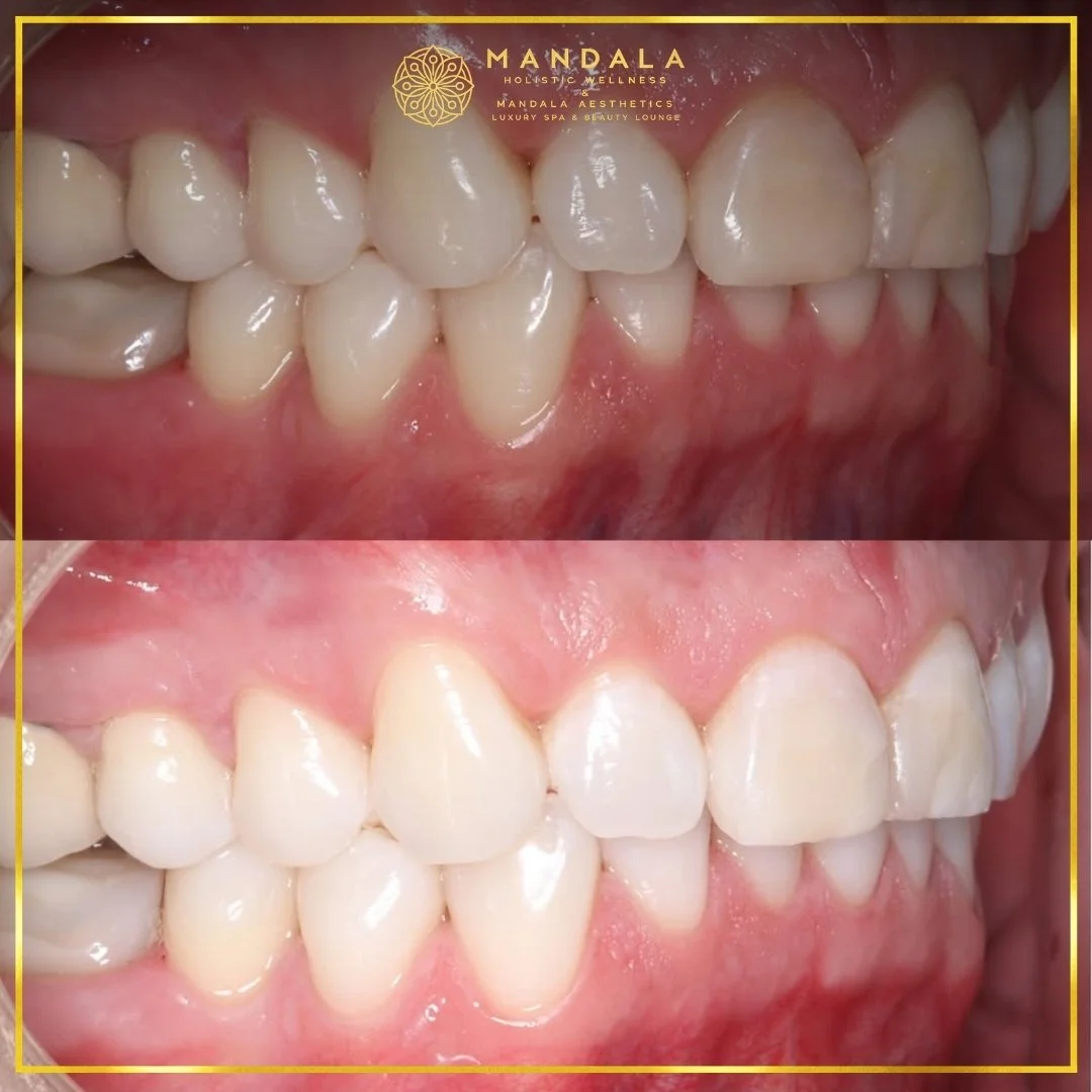 Teeth whitening before and after results showing a visibly white teeth,  brighter-looking smile at Mandala Aesthetics in Preston, Melbourne.
