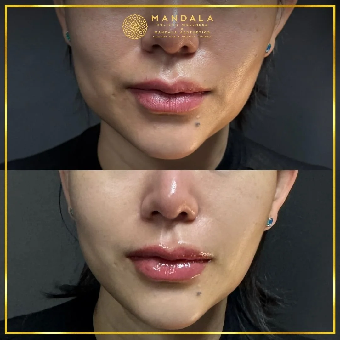 HIFU before and after results showing the lower face, chin and jawline at Mandala Aesthetics in Preston, Melbourne.