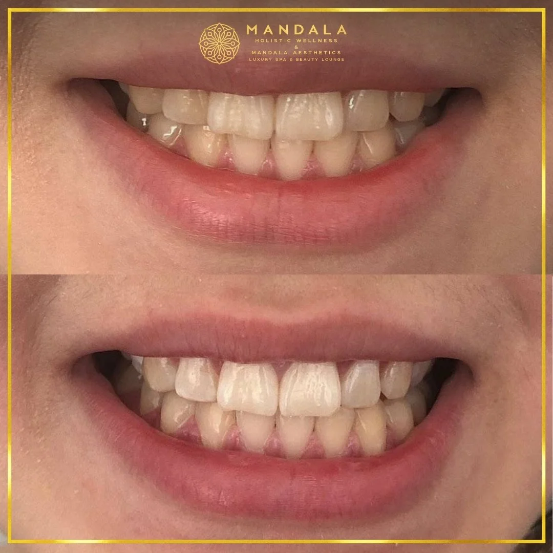 Teeth whitening before and after results showing a visibly white teeth,  brighter-looking smile at Mandala Aesthetics in Preston, Melbourne.