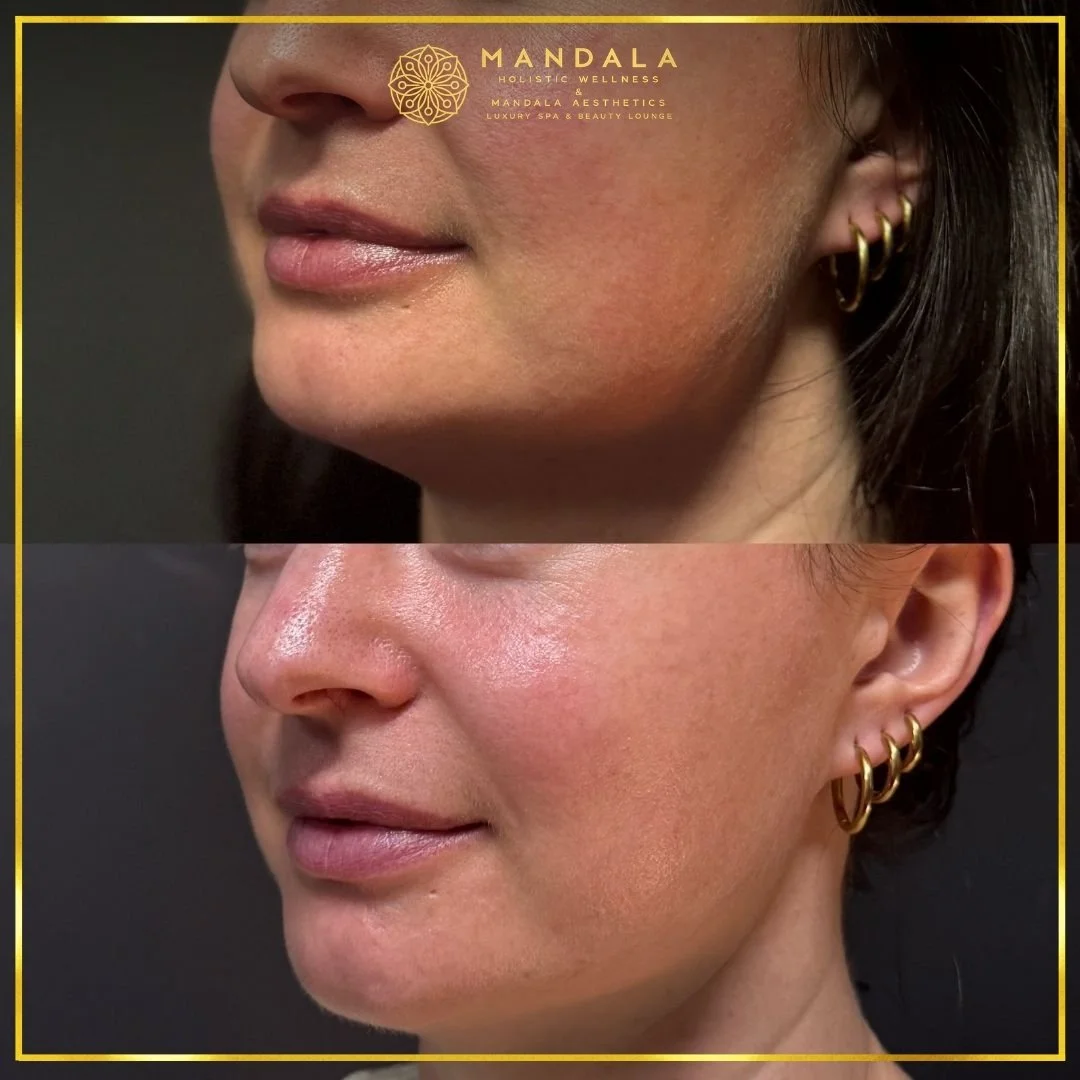 HIFU before and after results showing the lower face, chin and jawline at Mandala Aesthetics in Preston, Melbourne.