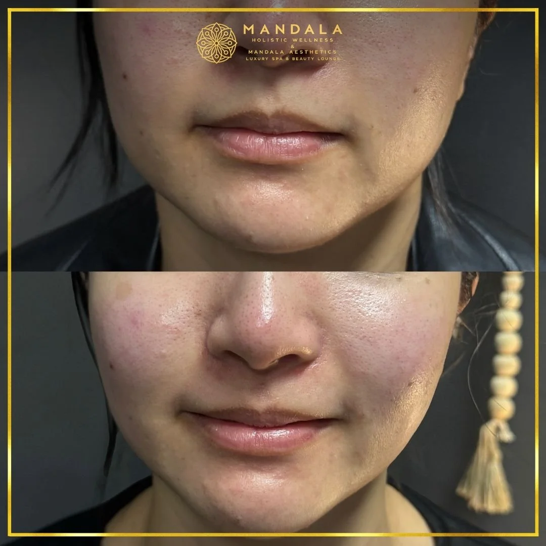 HIFU before and after results showing the lower face, chin and jawline at Mandala Aesthetics in Preston, Melbourne.