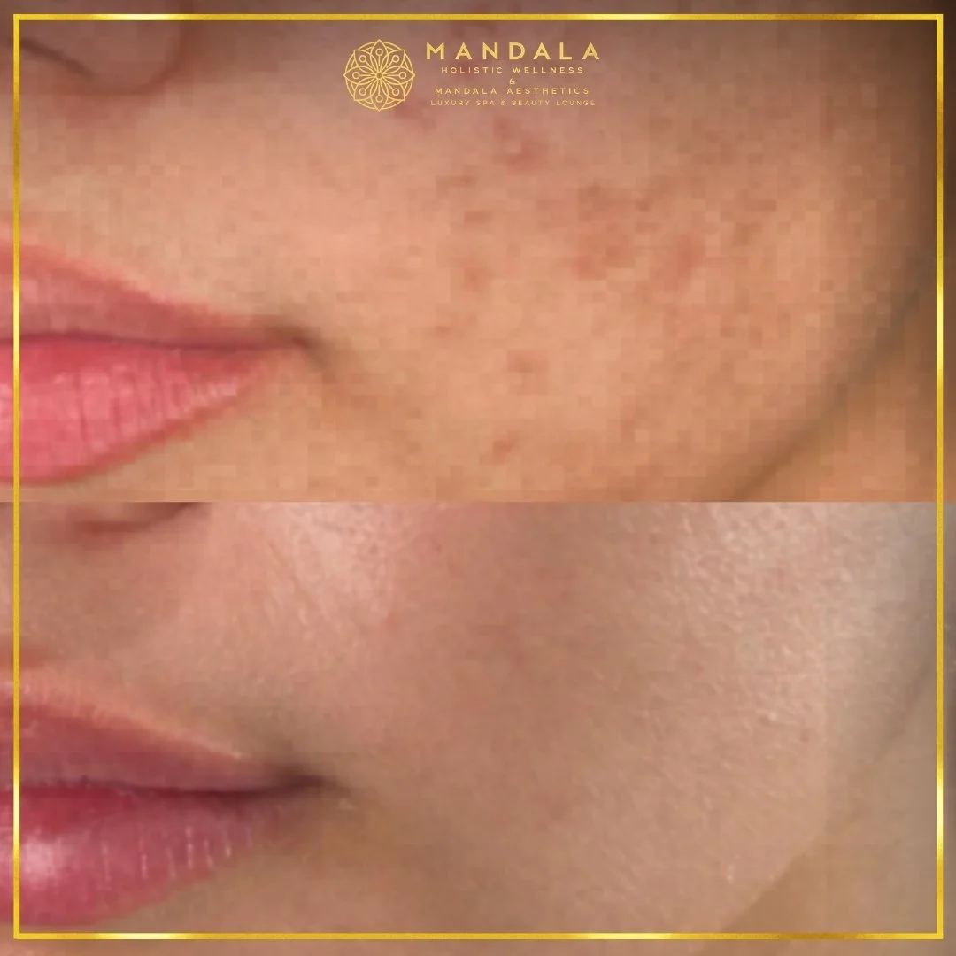 RF Microneedling before and after results showing improved-looking skin texture  and acne scars at Mandala Aesthetics in Preston, Melbourne.