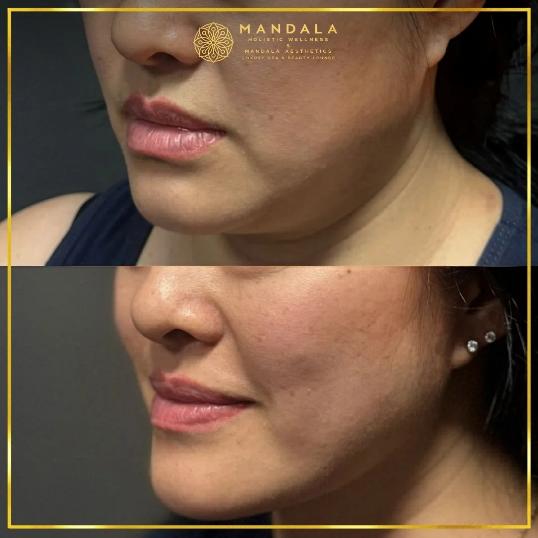 HIFU before and after results showing the lower face, chin and jawline at Mandala Aesthetics in Preston, Melbourne.