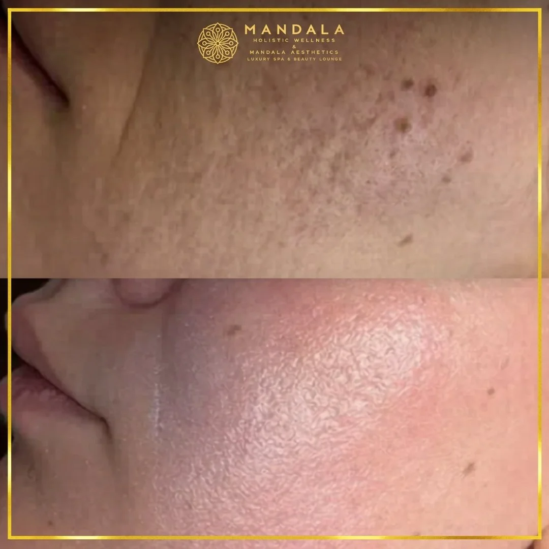 RF Microneedling before and after results showing improved-looking skin texture  and acne scars at Mandala Aesthetics in Preston, Melbourne.