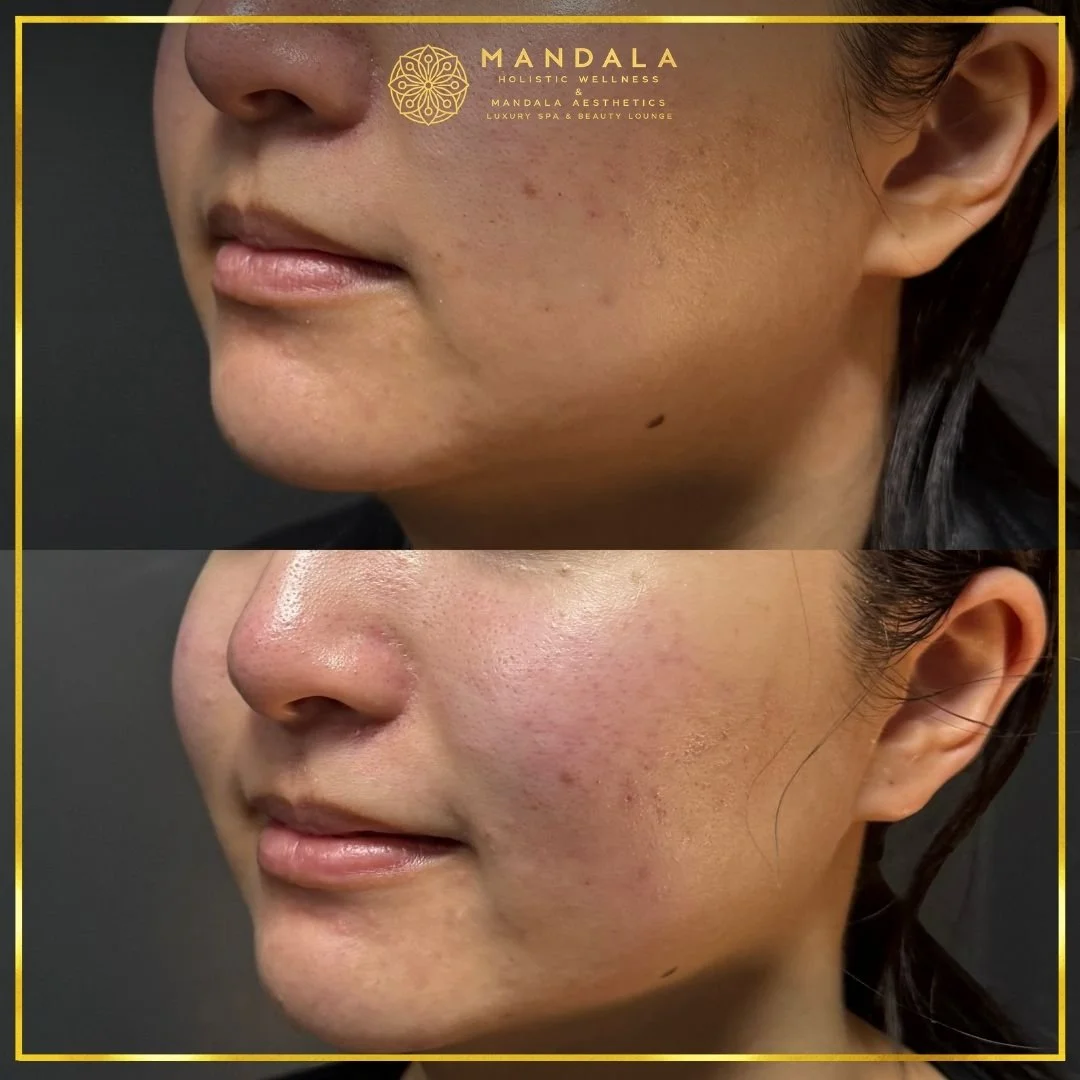 HIFU before and after results showing the lower face, chin and jawline at Mandala Aesthetics in Preston, Melbourne.