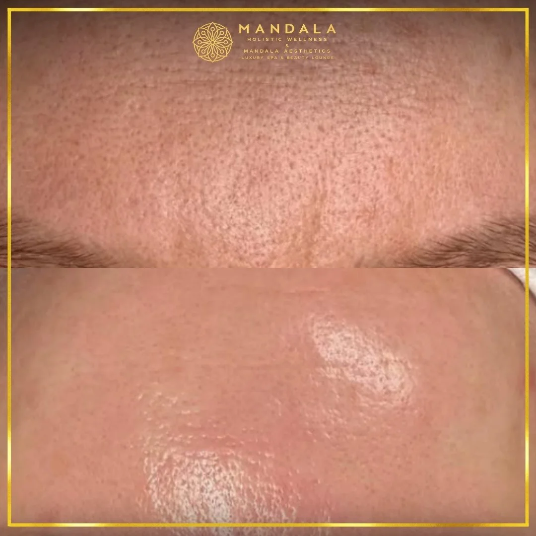 RF Microneedling before and after results showing improved-looking skin texture  and acne scars at Mandala Aesthetics in Preston, Melbourne.