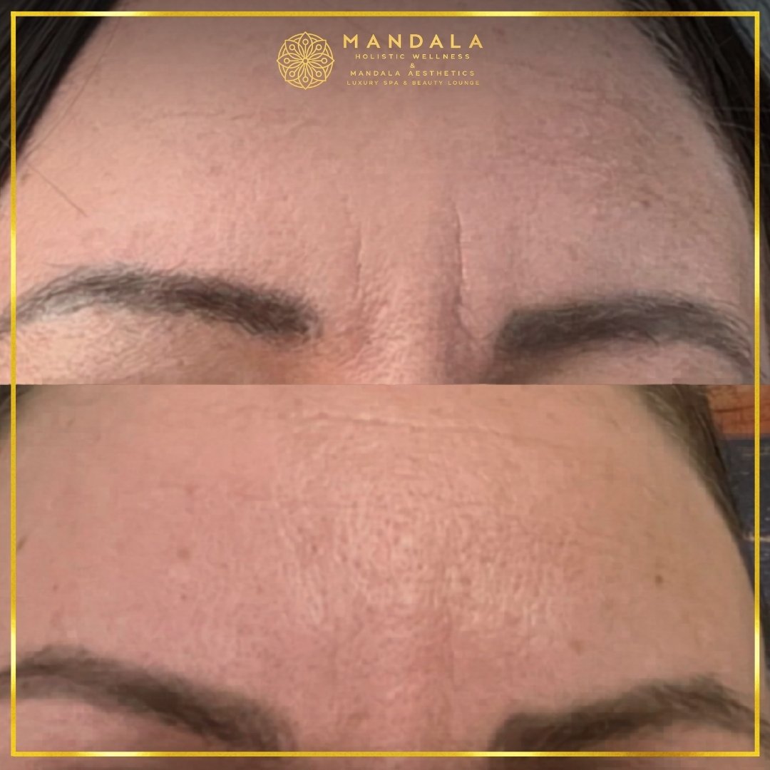 RF Microneedling before and after results showing improved-looking skin texture  and acne scars at Mandala Aesthetics in Preston, Melbourne.