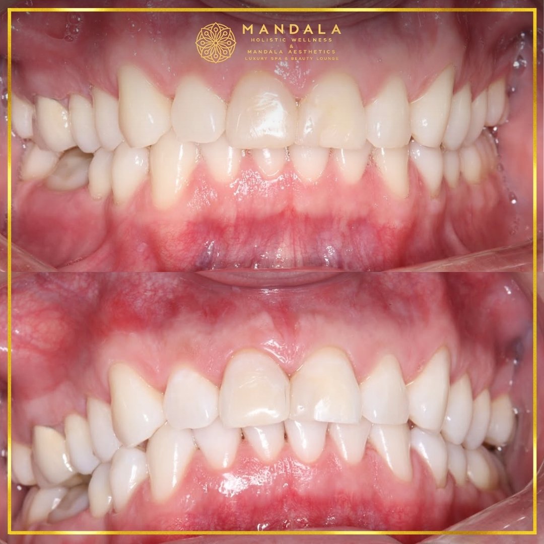 Teeth whitening before and after results showing a visibly white teeth,  brighter-looking smile at Mandala Aesthetics in Preston, Melbourne.