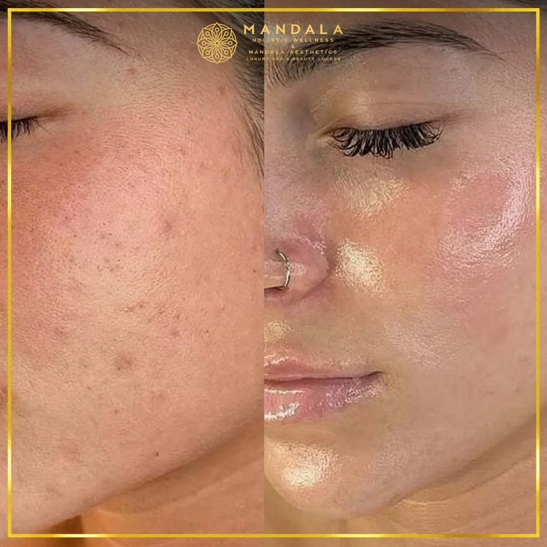 Facial treatment before and after results showing refreshed, hydrated and glowing-looking skin at Mandala Aesthetics in Preston, Melbourne.