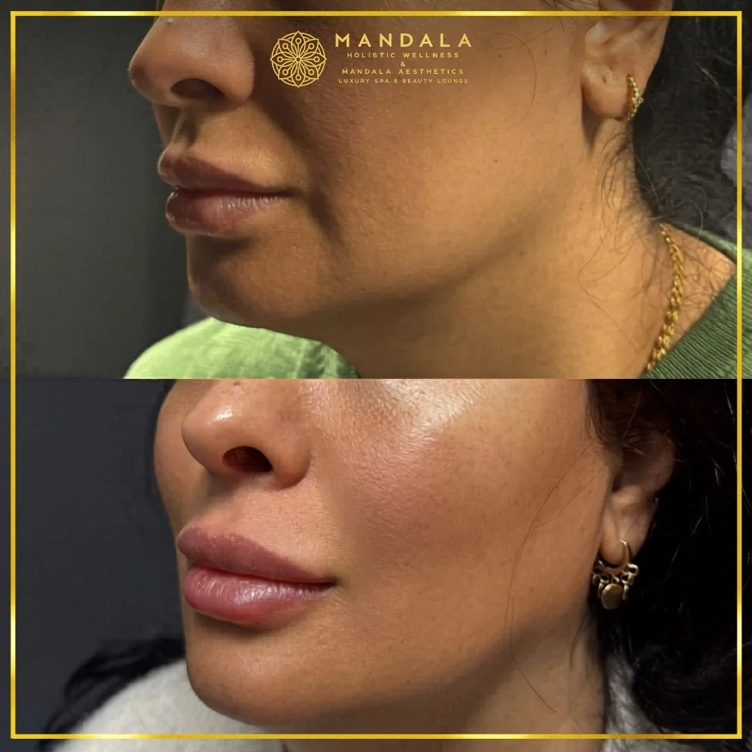 HIFU before and after results showing the lower face, chin and jawline at Mandala Aesthetics in Preston, Melbourne.