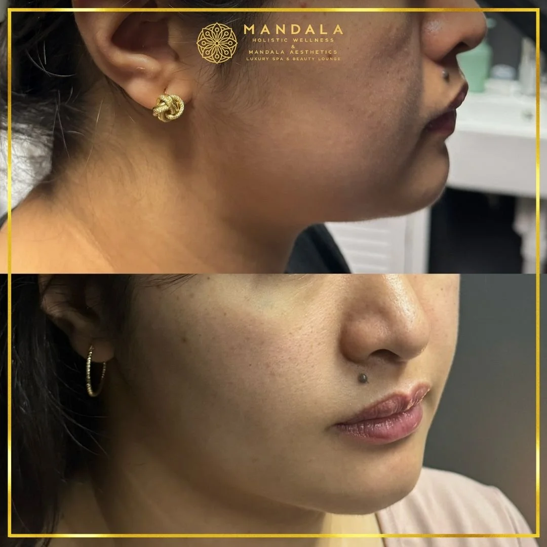 HIFU before and after results showing the lower face, chin and jawline at Mandala Aesthetics in Preston, Melbourne.