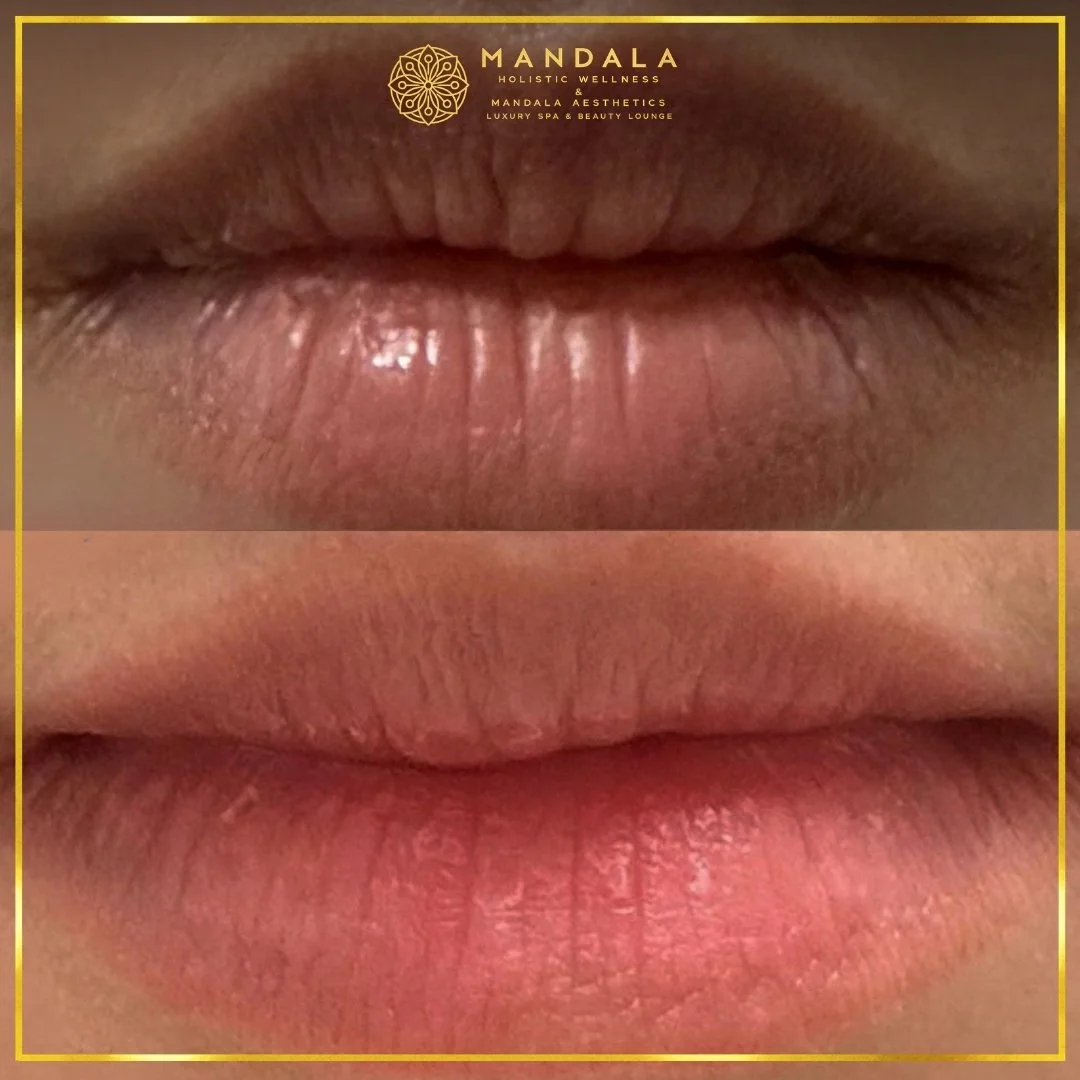 RomaPink Lip Treatment before and after results showing a more even, hydrated lips and naturally pink-looking lip tone at Mandala Aesthetics in Preston, Melbourne.