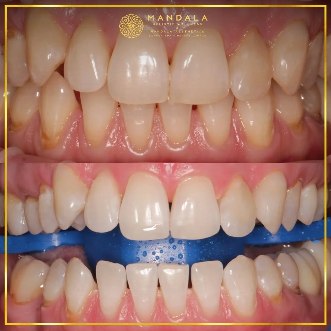 Teeth whitening before and after results showing a visibly white teeth,  brighter-looking smile at Mandala Aesthetics in Preston, Melbourne.