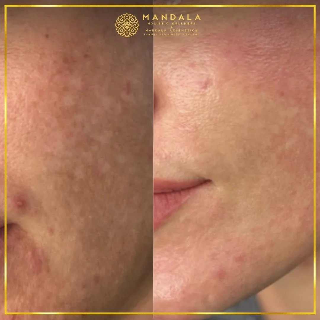 WhiteLab Spot Melanin Removal before and after results showing the appearance of age spots, sun spots , freckles, melasma, pigmentation at Mandala Aesthetics in Preston, Melbourne.