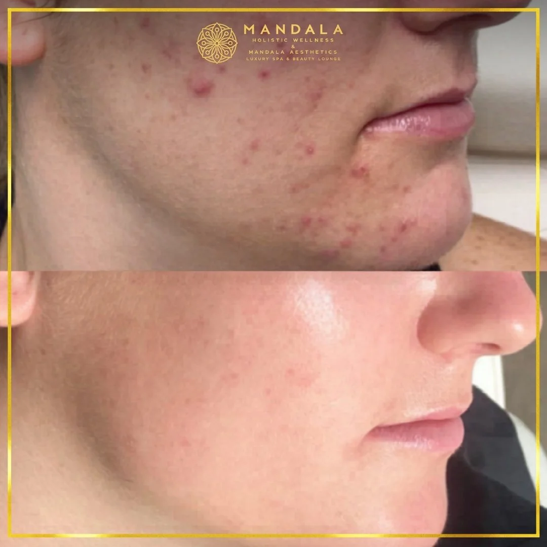 Facial treatment before and after results showing refreshed, hydrated and glowing-looking skin at Mandala Aesthetics in Preston, Melbourne.
