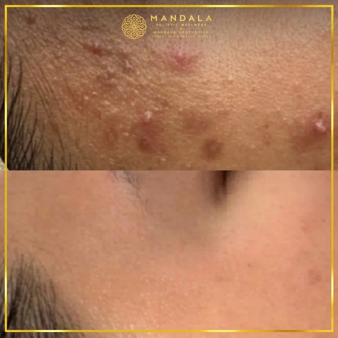 Facial treatment before and after results showing refreshed, hydrated and glowing-looking skin at Mandala Aesthetics in Preston, Melbourne.