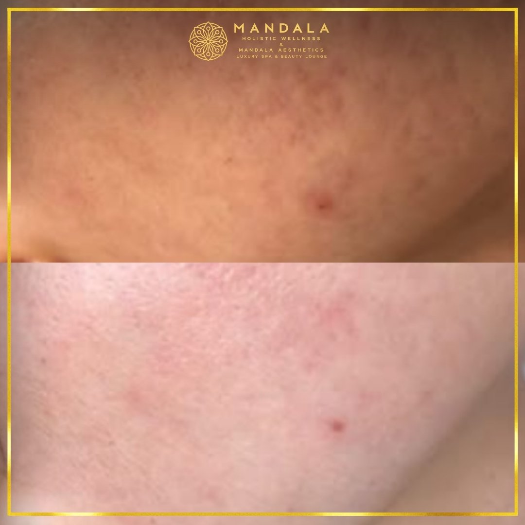 RF Microneedling before and after results showing improved-looking skin texture  and acne scars at Mandala Aesthetics in Preston, Melbourne.