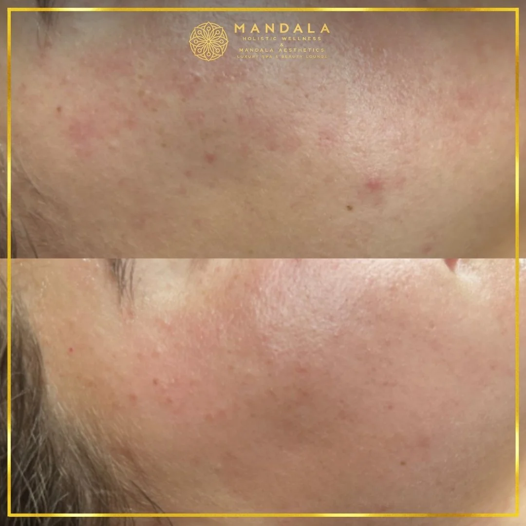 Facial treatment before and after results showing refreshed, hydrated and glowing-looking skin at Mandala Aesthetics in Preston, Melbourne.