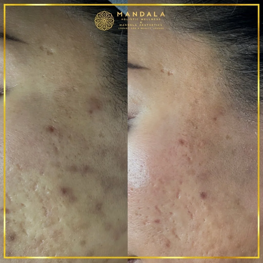 Facial treatment before and after results showing refreshed, hydrated and glowing-looking skin at Mandala Aesthetics in Preston, Melbourne.