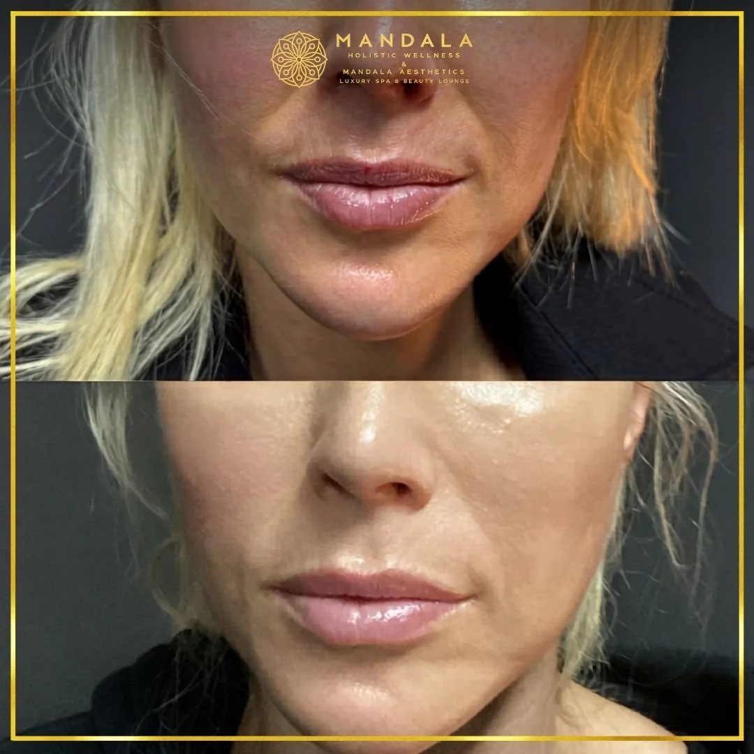HIFU before and after results showing the lower face, chin and jawline at Mandala Aesthetics in Preston, Melbourne.