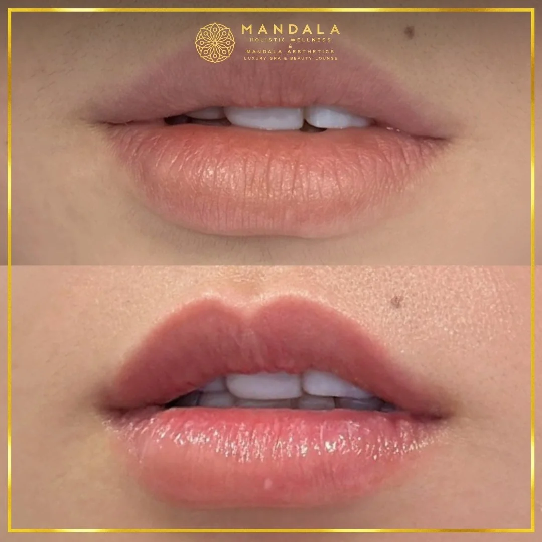 RomaPink Lip Treatment before and after results showing a more even, hydrated lips and naturally pink-looking lip tone at Mandala Aesthetics in Preston, Melbourne.