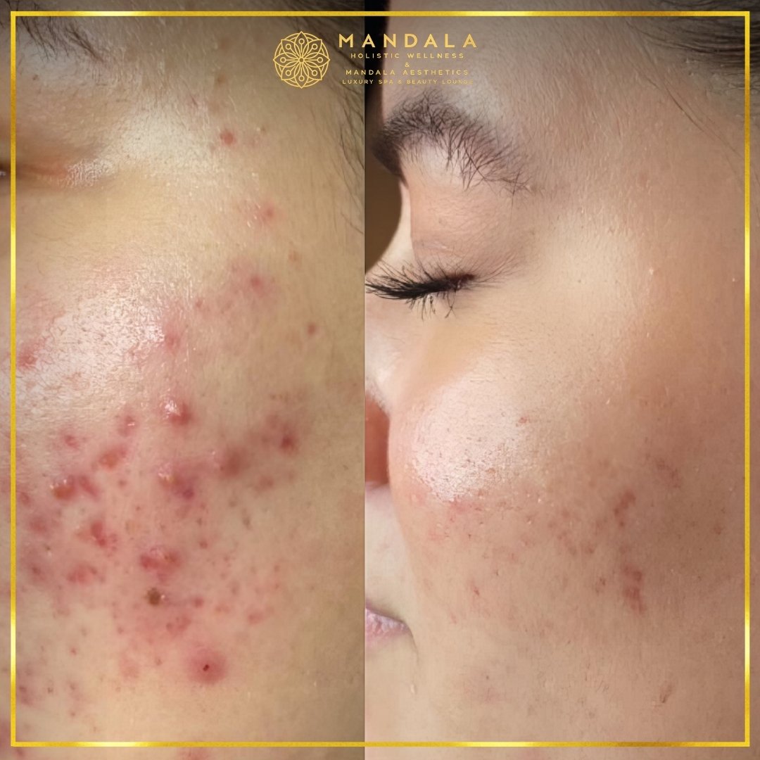 Facial treatment before and after results showing refreshed, hydrated and glowing-looking skin at Mandala Aesthetics in Preston, Melbourne.