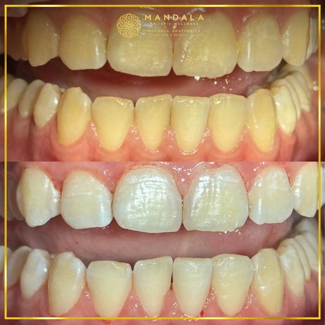 Teeth whitening before and after results showing a visibly white teeth,  brighter-looking smile at Mandala Aesthetics in Preston, Melbourne.
