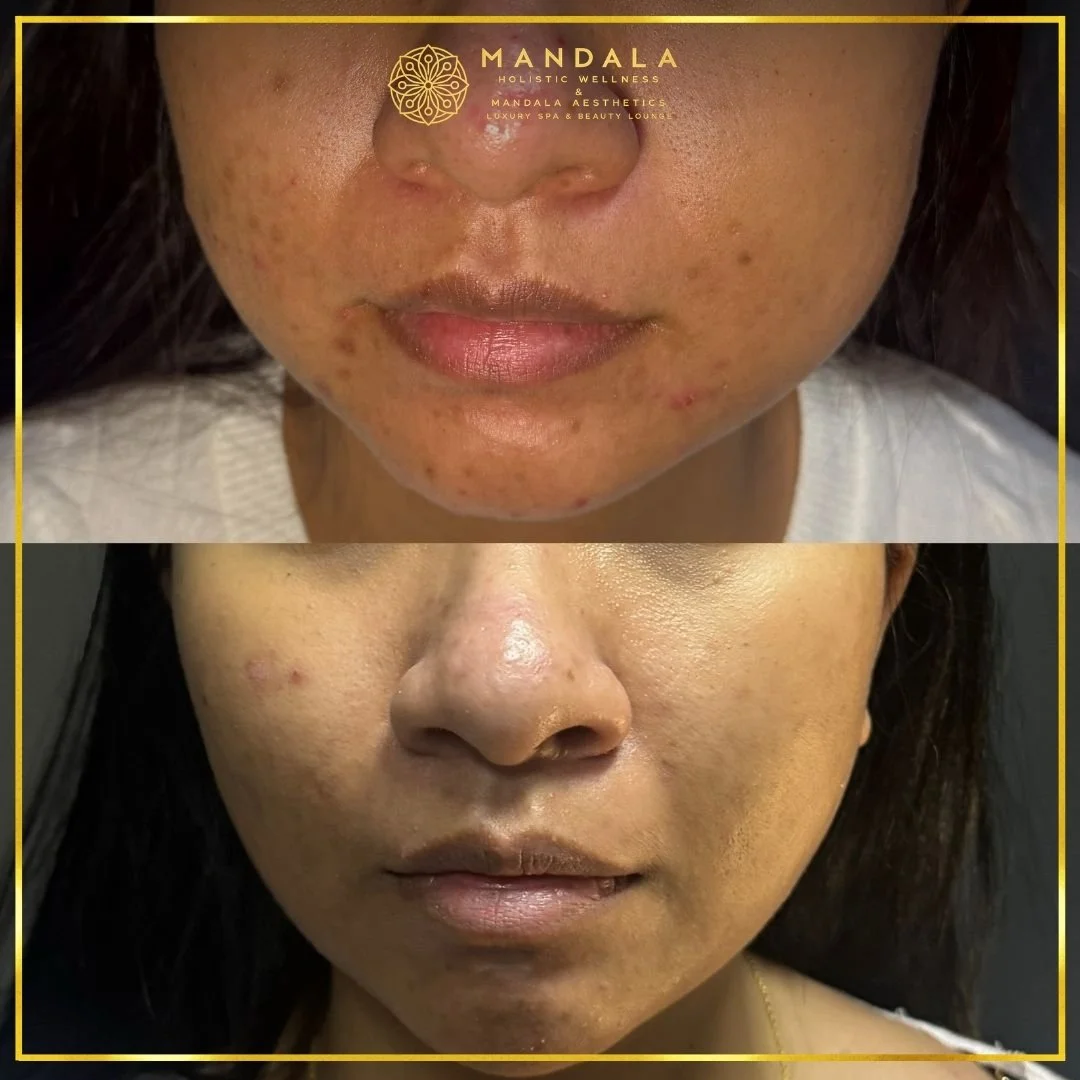 HIFU before and after results showing the lower face, chin and jawline at Mandala Aesthetics in Preston, Melbourne.