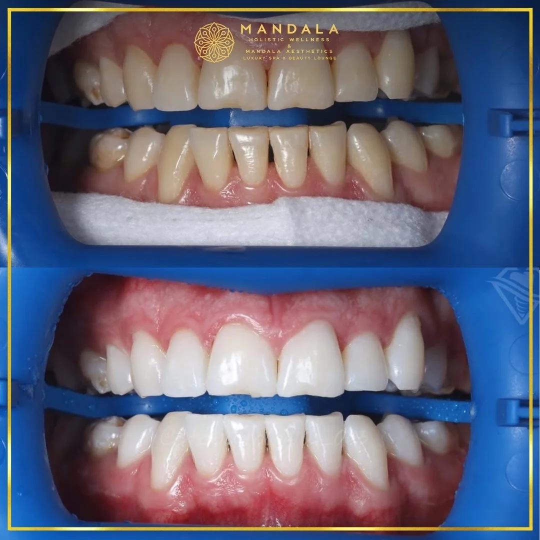 Teeth whitening before and after results showing a visibly white teeth,  brighter-looking smile at Mandala Aesthetics in Preston, Melbourne.