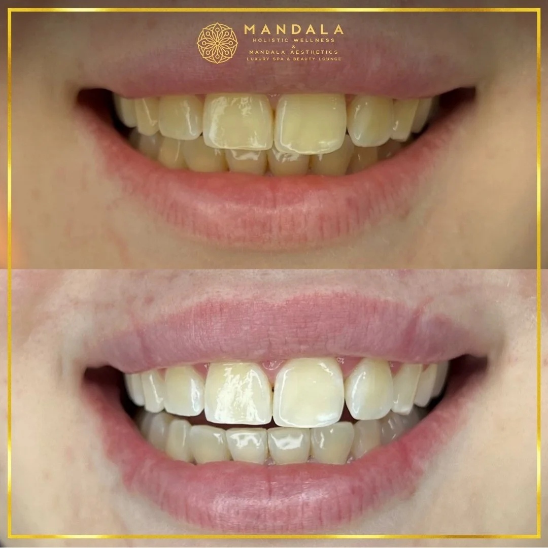 Teeth whitening before and after results showing a visibly white teeth,  brighter-looking smile at Mandala Aesthetics in Preston, Melbourne.