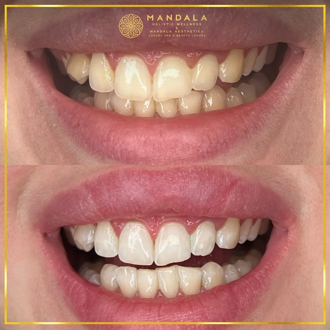 Teeth whitening before and after results showing a visibly white teeth,  brighter-looking smile at Mandala Aesthetics in Preston, Melbourne.
