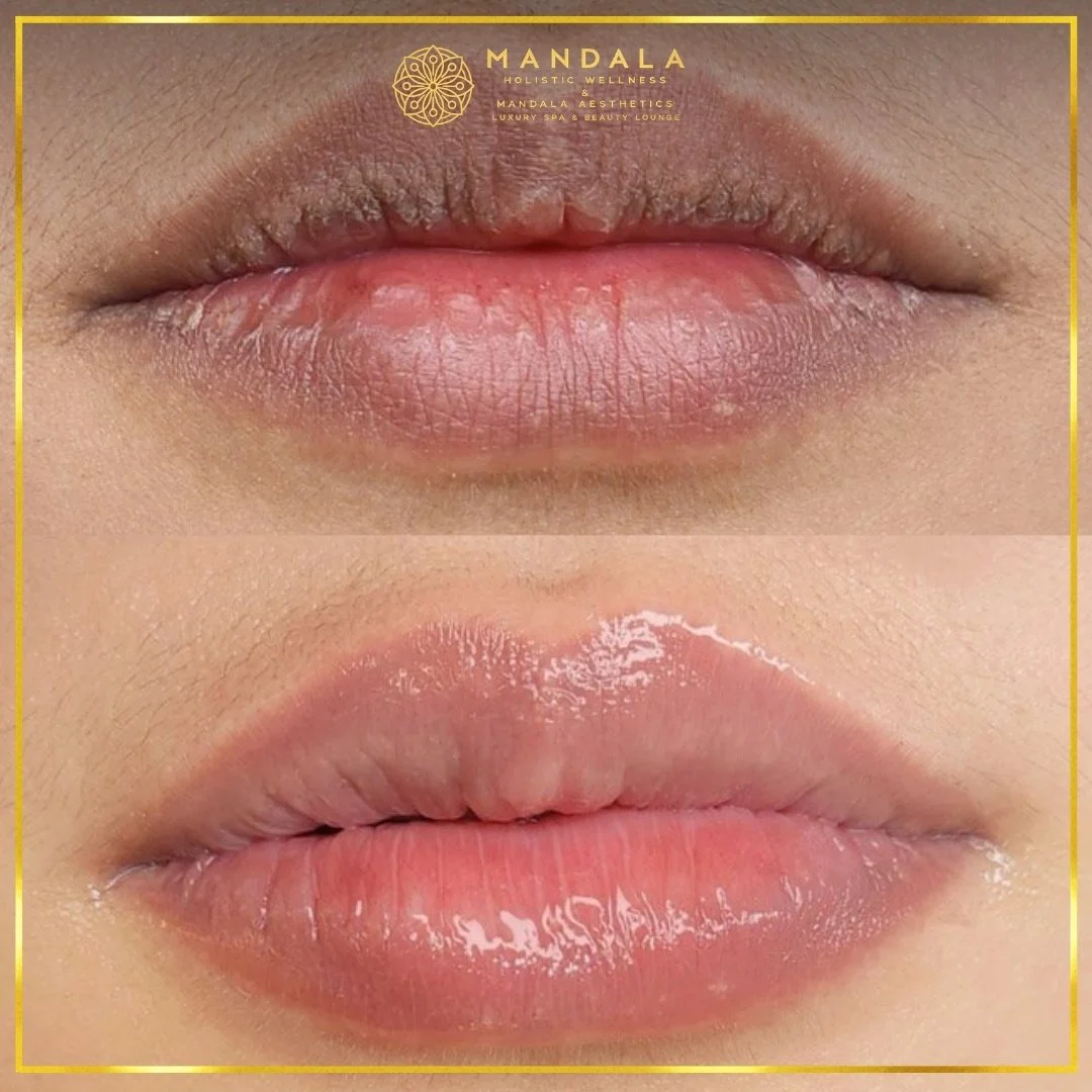 RomaPink Lip Treatment before and after results showing a more even, hydrated lips and naturally pink-looking lip tone at Mandala Aesthetics in Preston, Melbourne.