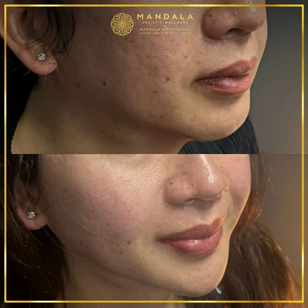 HIFU before and after results showing the lower face, chin and jawline at Mandala Aesthetics in Preston, Melbourne.