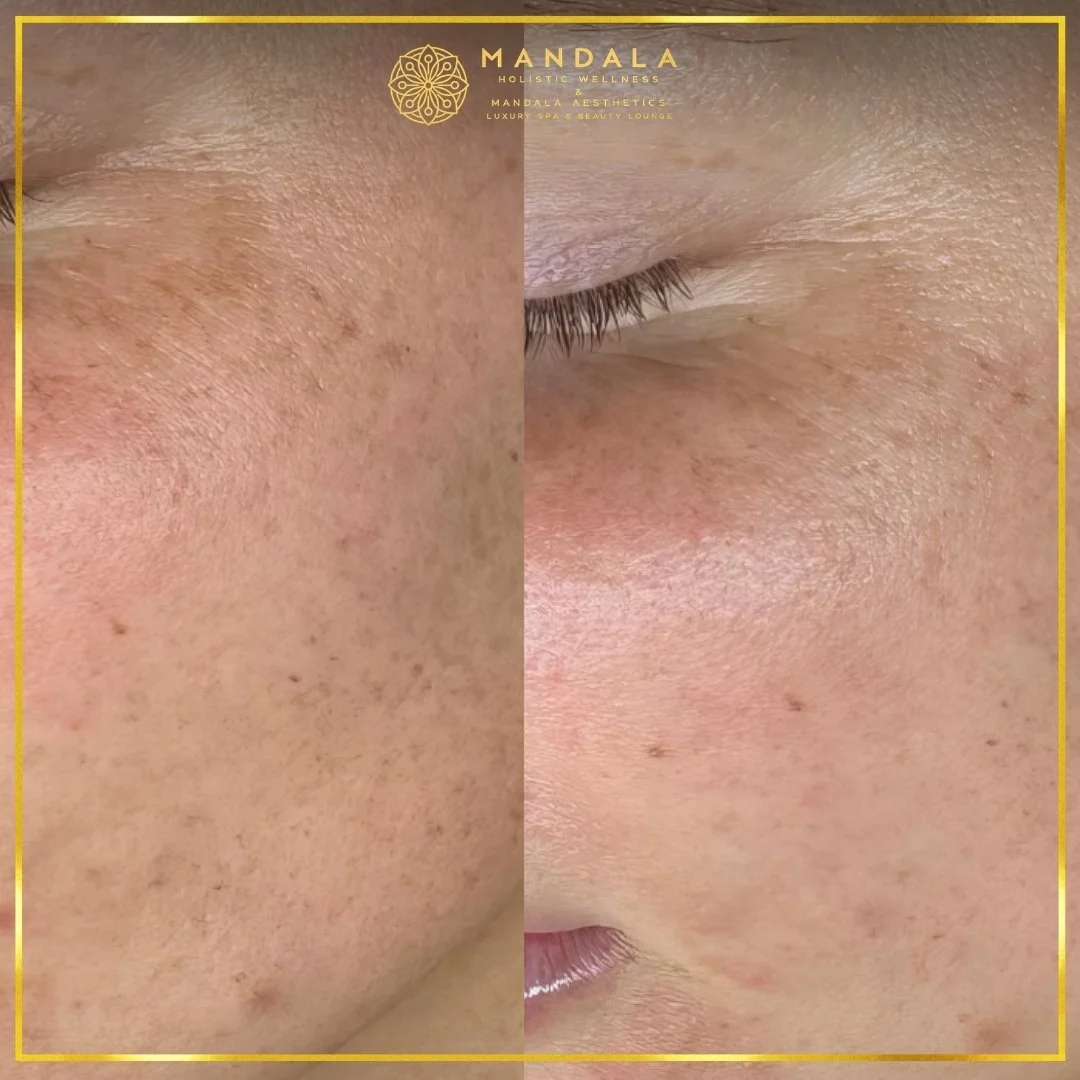 WhiteLab Spot Melanin Removal before and after results showing the appearance of age spots, sun spots , freckles, melasma, pigmentation at Mandala Aesthetics in Preston, Melbourne.