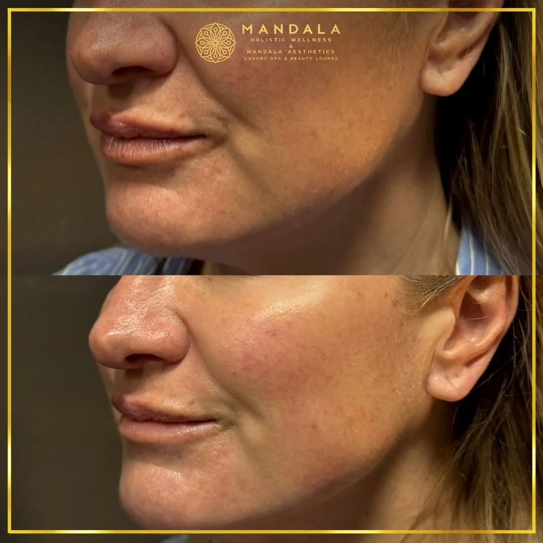 HIFU before and after results showing the lower face, chin and jawline at Mandala Aesthetics in Preston, Melbourne.