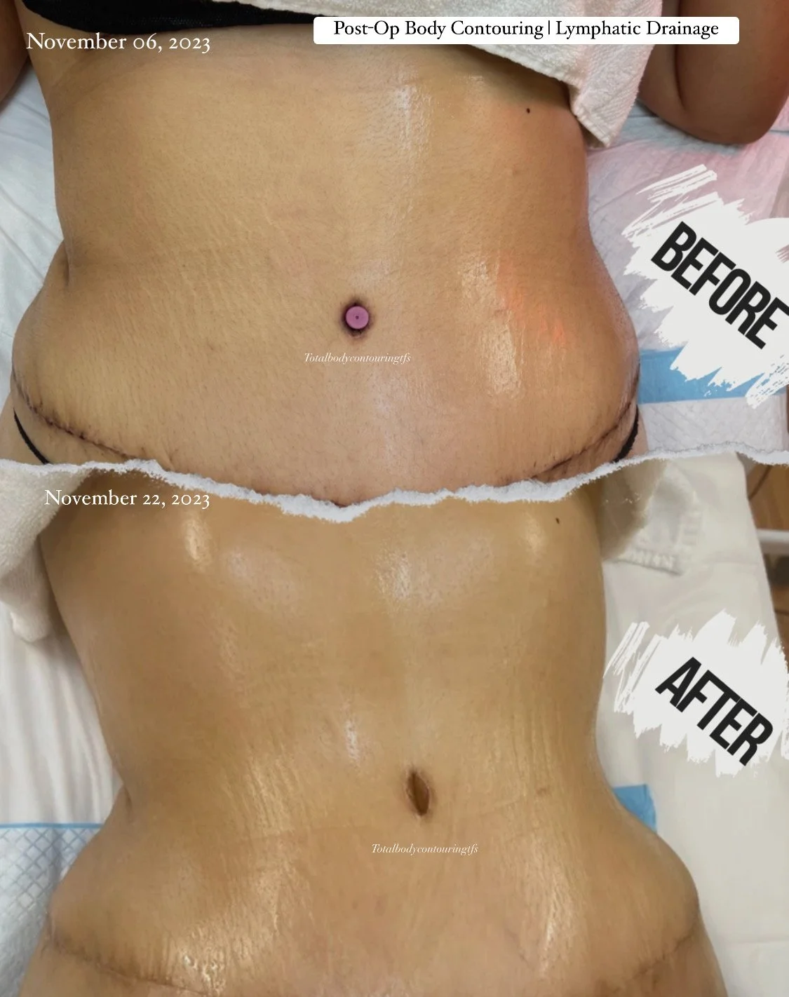 Post Op Tummy Tuck Lymphatic Drainage .jpeg