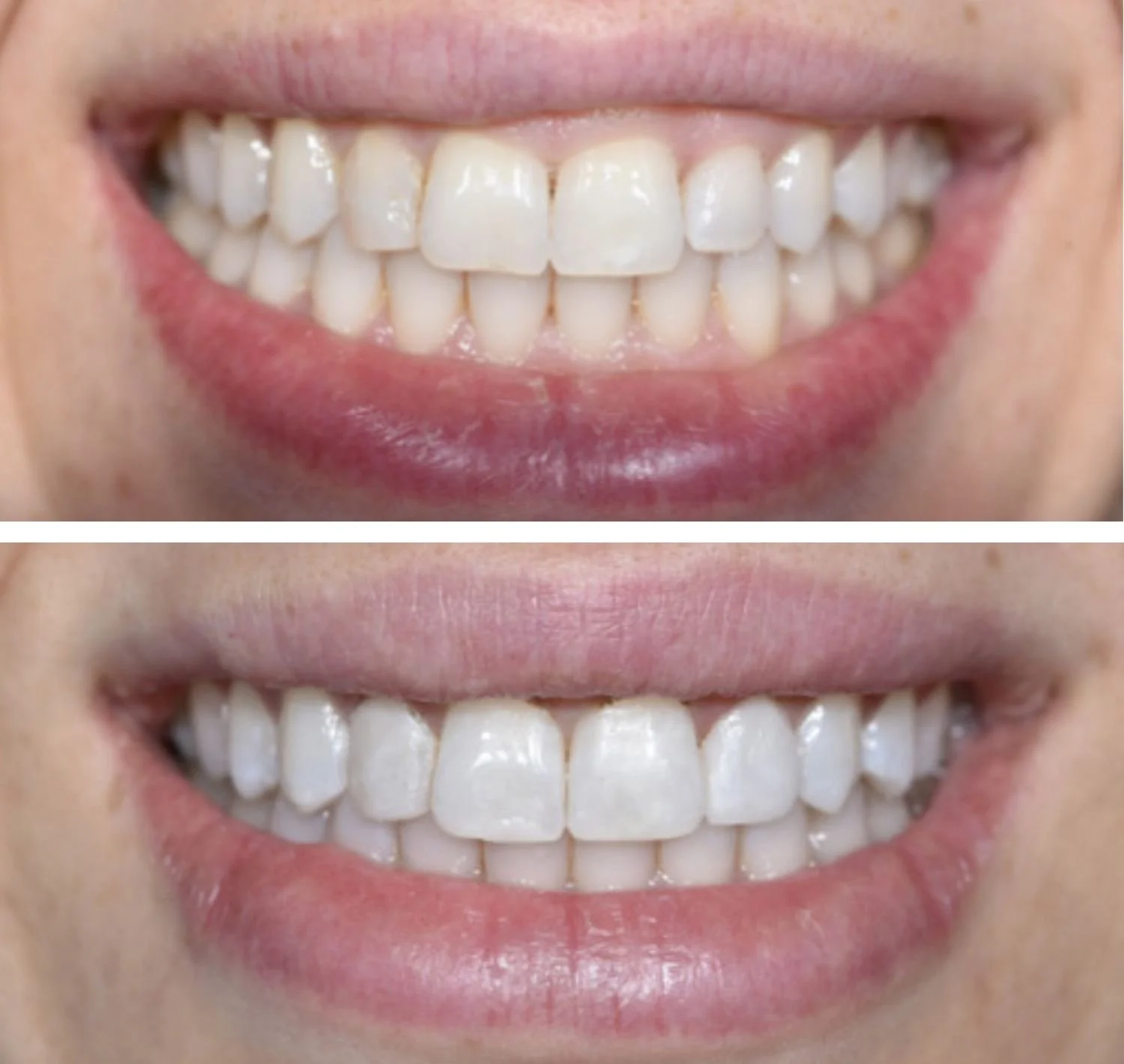 smile-design-temporary-trial-smile.jpg