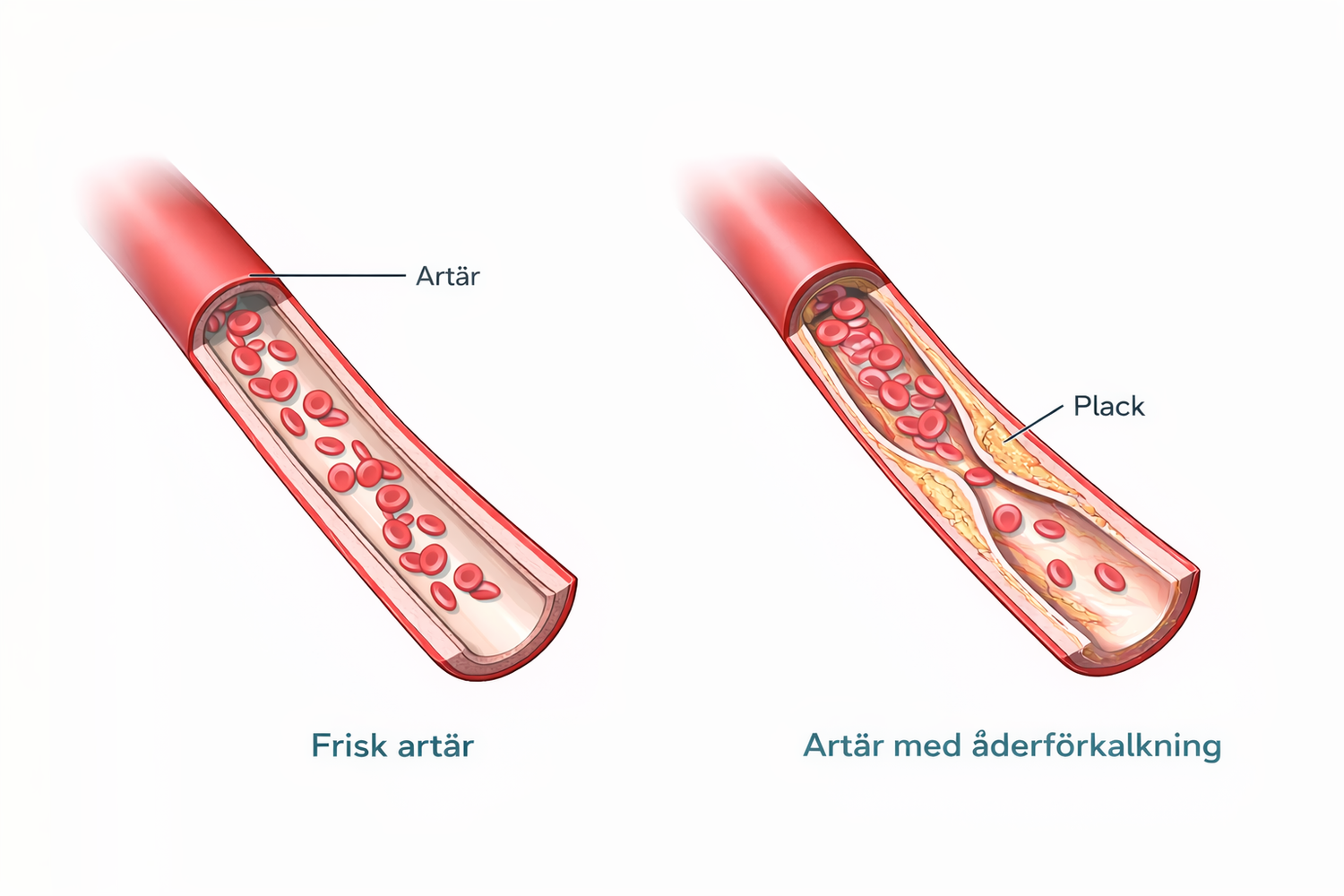 Illustration: frisk artär jämfört med artär med plack och åderförkalkning