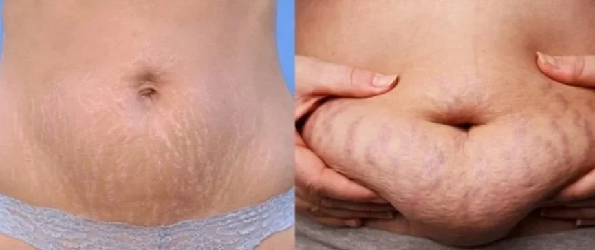 Red V.S. White Stretch Marks