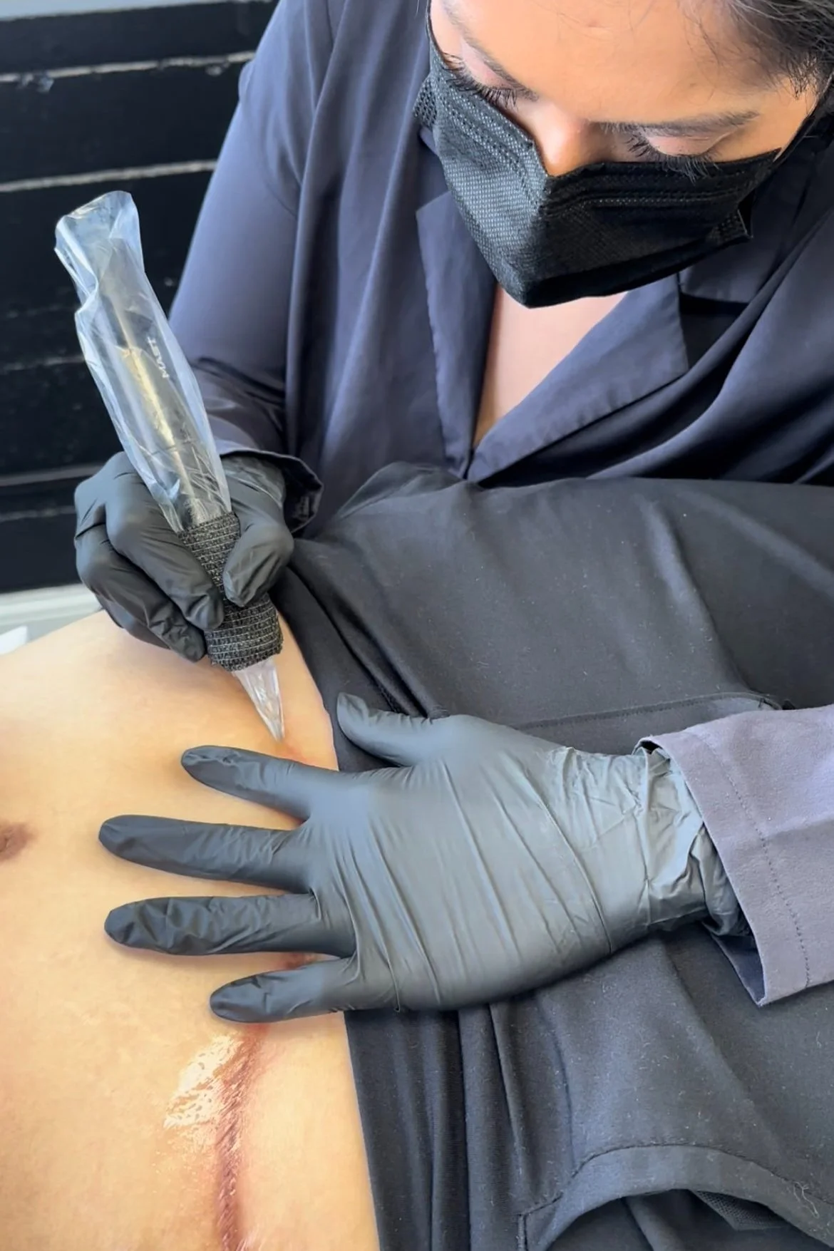 Understanding Dark Scars: Causes & Effective Treatment