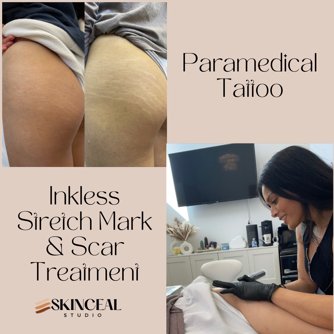 inkless stretch mark training, stretch mark treatment, stretch mark removal, stretch mark removal training