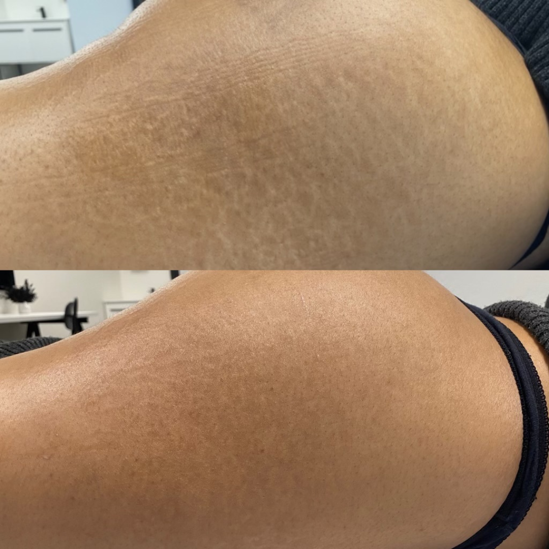 stretch mark removal results