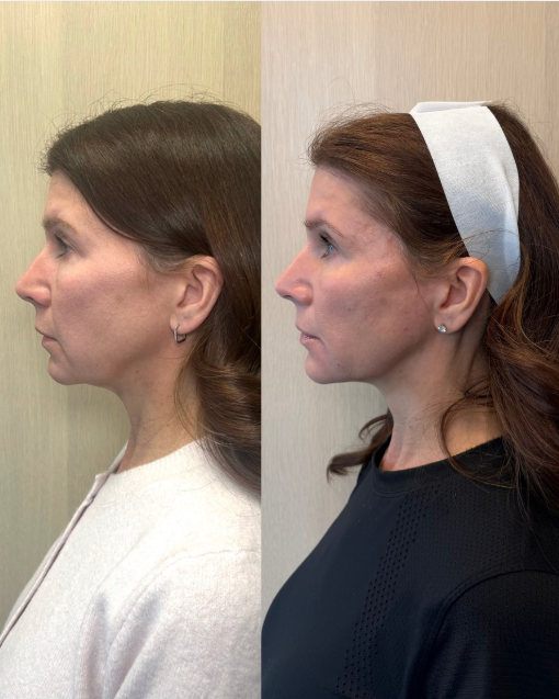 Side-by-side before and after photos of a woman's face showing possible cosmetic or skincare treatment results, focusing on skin tone and texture improvements.