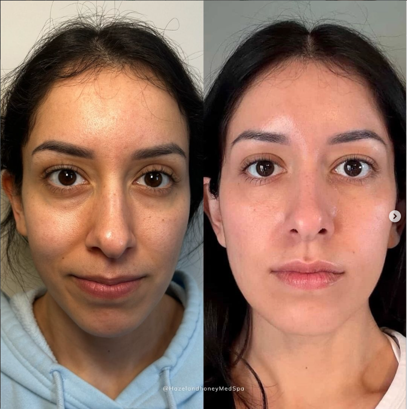 Before and after images of a woman's facial appearance, showing skin improvement.