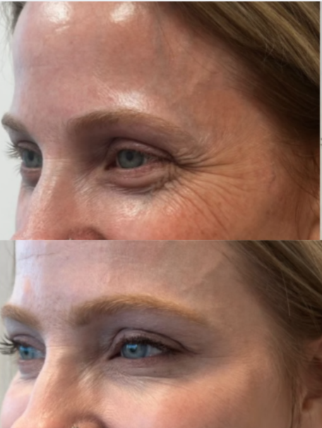 Before and after comparison of a woman's face showing cosmetic changes, focusing on skin texture and makeup.