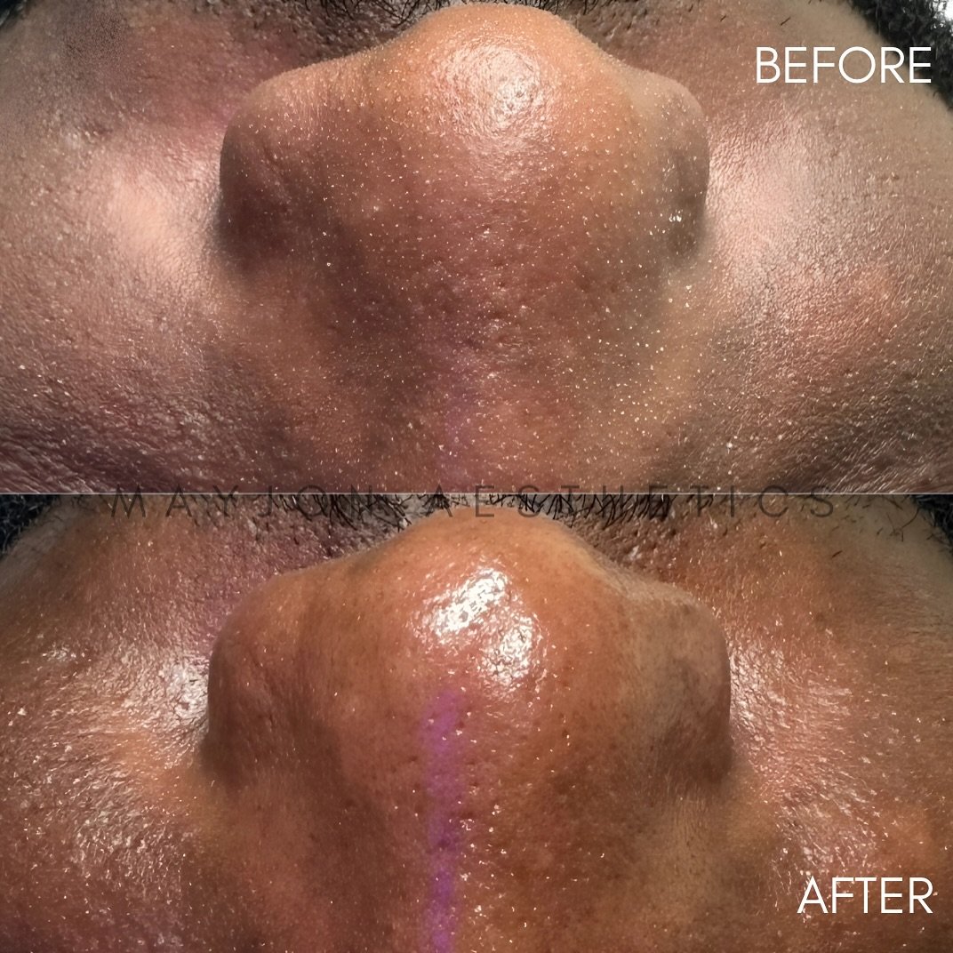 Men deserve pampering too. Skincare is an investment, not an expense. 

Book a FREE consultation with the link in our bio! 
&bull;
&bull;
&bull; 

#facial #esthetician #beforeandafter #medspa #westchester #acne #filler #botox #laserhairremoval #laser