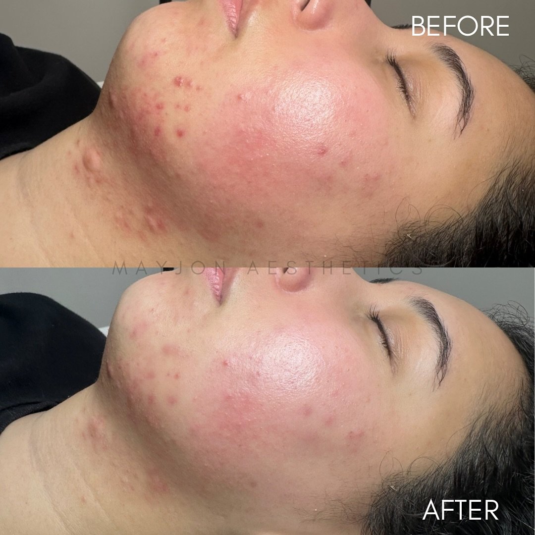 Why settle for one-size-fits-all skincare? Our customized facials are designed to meet YOUR skin&rsquo;s unique needs! Whether you&rsquo;re battling acne, dryness, or just need a radiant boost, we&rsquo;ve got the perfect treatment for you. 

Check b